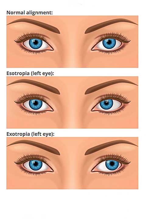 What is Strabismus? | Stamper Optometry | San Francisco CA