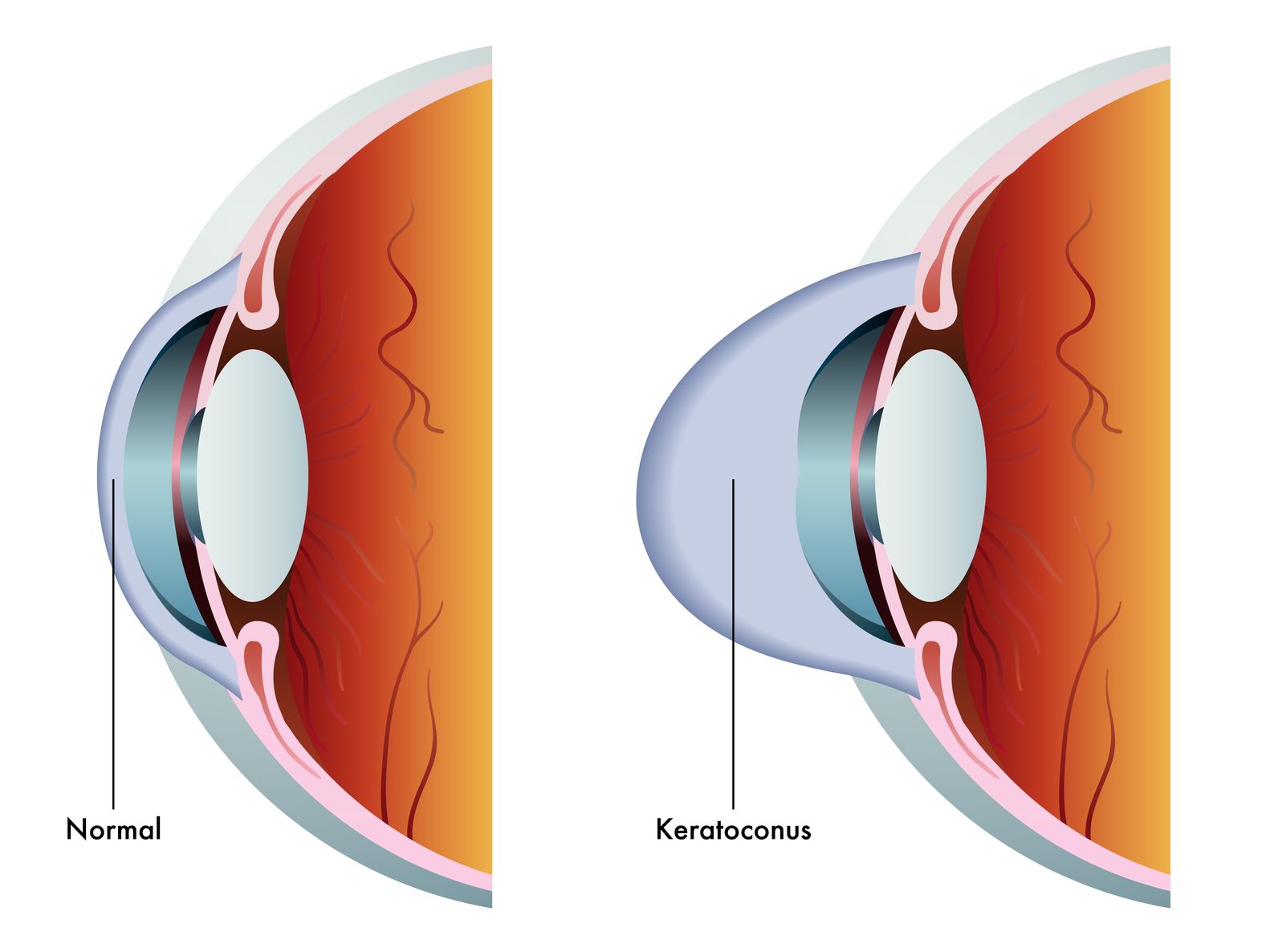 What is Keratoconus? Stamper Optometry San Francisco CA